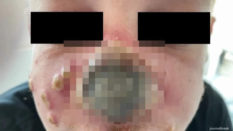 Monkeypox Patient Nose Rotting