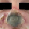 Monkeypox Patient Nose Rotting